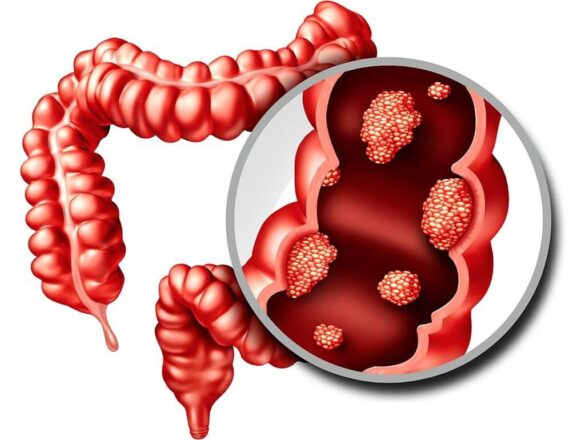 Epidemiology and socioeconomic correlates of colorectal cancer in Asia in 2020 and its projection to 2040 – Nature